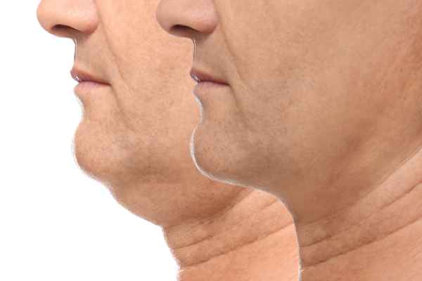 HIFU - Breakthrough in Anti - ageing 2 hifu results Halesowen
