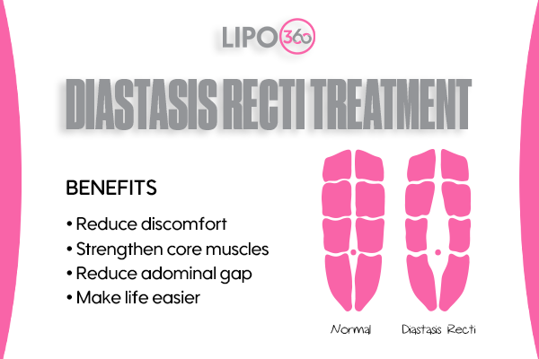 diastasis recti treatment Halesowen