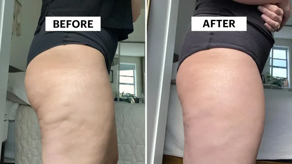 Do Toning Exercise Halesowen Really Tackle Cellulite?