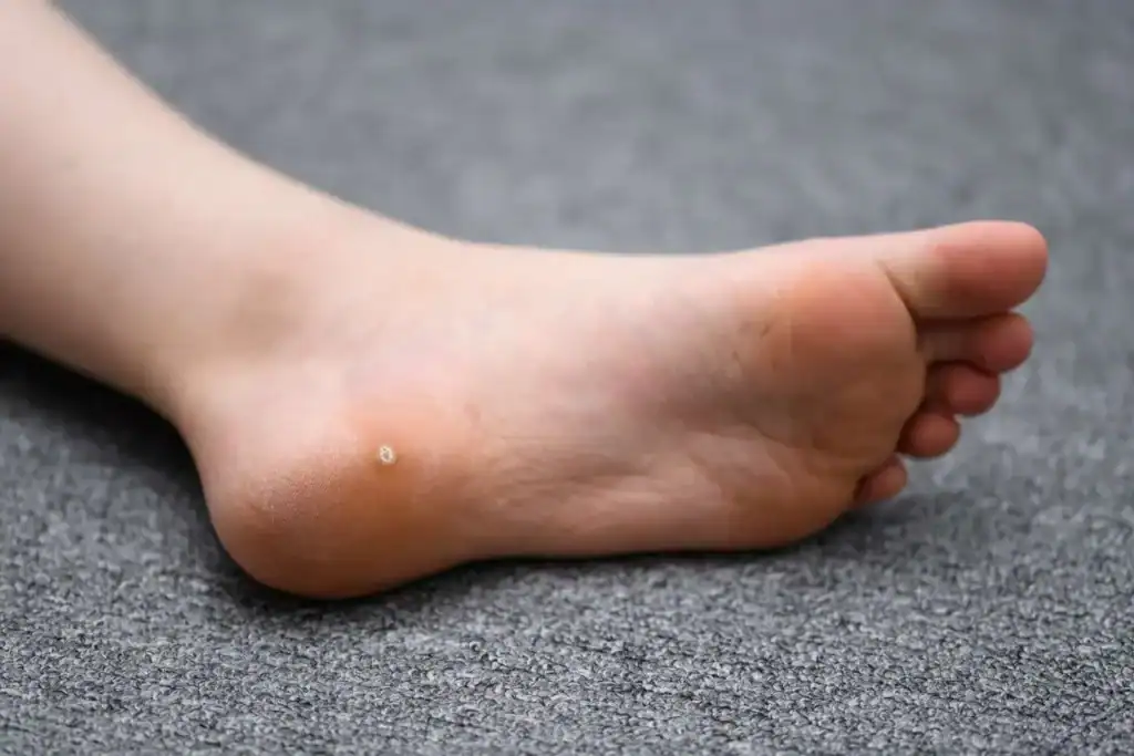 Cryotherapy For Warts And Also Verrucas 2 Image of verruca on the bottom of the foot that able to be treated with Cryotherapy Halesowen