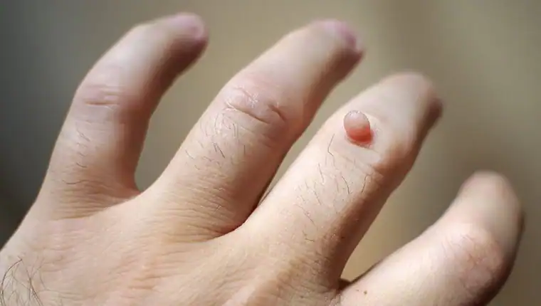 Cryotherapy For Warts And Also Verrucas 1 Image of blemish that Cryotherapy Halesowen can remove with Lipo 360.