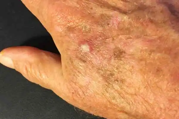 Image of Actinic keratoses Halesowen on a person hand