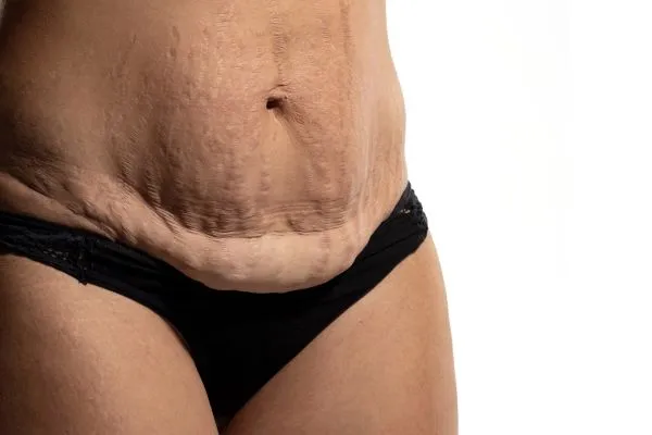The science behind skin tightening Halesowen picture of a woman's sagging skin on the stomach